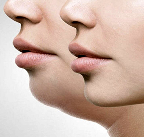 بهترین روش رفع غبغب | بررسی روش‌های بدون جراحی و با جراحی